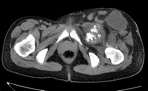 Pelvic Osteosarcoma CT Sumer S Radiology Blog