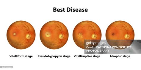 Stages Of Best Vitelliform Macular Dystrophy Illustration High-Res ...