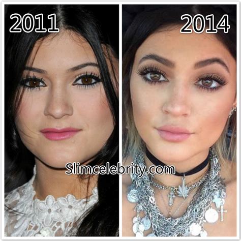 Kylie Jenner Plastic Surgery Before And After Photos Nose Job Lip Injections Botox Injections