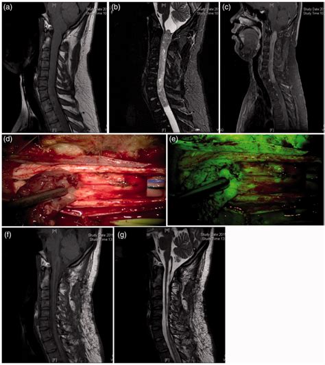 Intramedullary Spinal Cord Ependymoma At The C1T1 Segment A C