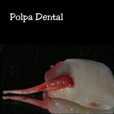 Para Quem Tem Curiosidade Uma Polpa Dental Inteira E Viva De Um