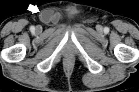 CT Findings In Urinary Diversion After Radical Cystectomy Postsurgical