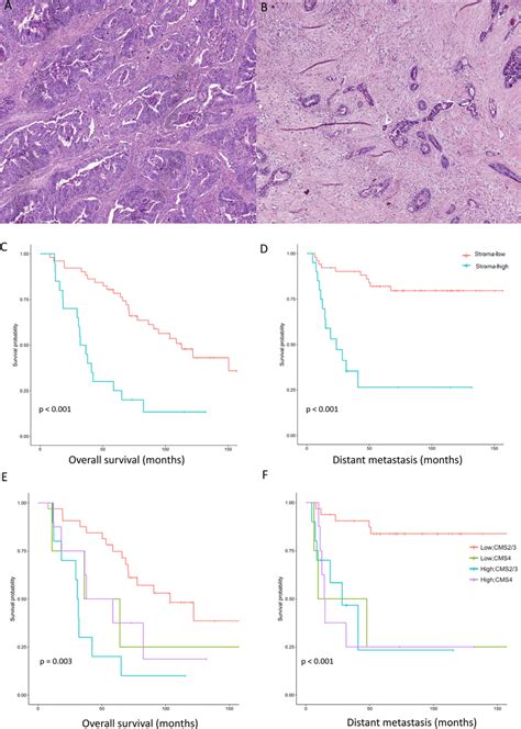 The Tumor Stroma Ratio Identifies Patients With Poor Survival Tumor