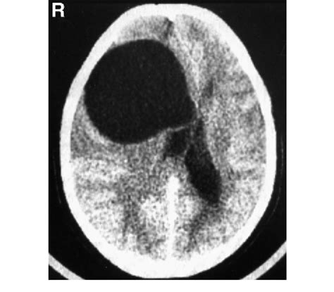 Cranial Computed Tomography Scan Revealing A Primary Cerebral Hydatid