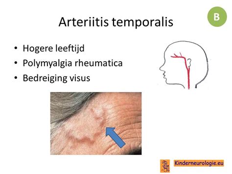 Hoofdpijn Kinderneurologie