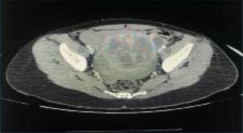 Abdominal And Pelvic Contrast Enhanced Computed Tomography Ct Imaging Download Scientific