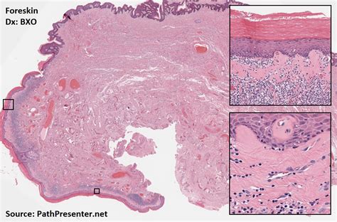 Balanitis Xerotica Obliterans Histology