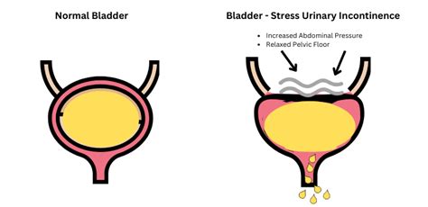 What Is Stress Incontinence Markham Pelvic Health