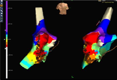 D Electroanatomical Mapping System With Right Anterior Oblique And