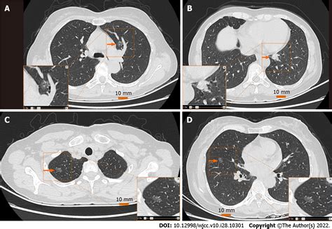 One Stage Resection Of Four Genotypes Of Bilateral Multiple Primary Lung Adenocarcinoma A Case