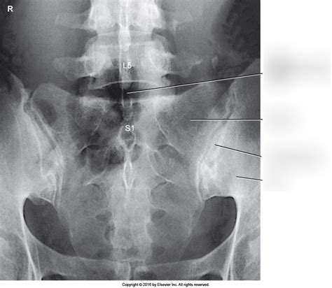 Figure Ap Axial Lumbosacral Junction And Sacroiliac Joints