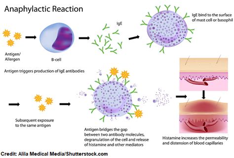 What Is Anaphylactic Shock