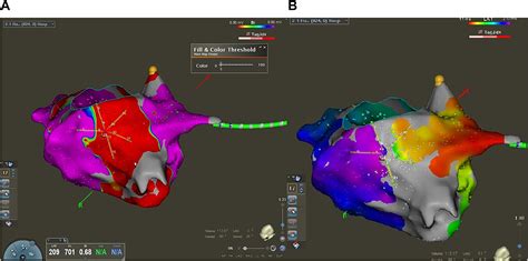 Pulsed Field Ablation Of The Cavotricuspid Isthmus Using A Multispline