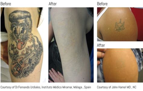 Exeter Laser Tattoo Removal