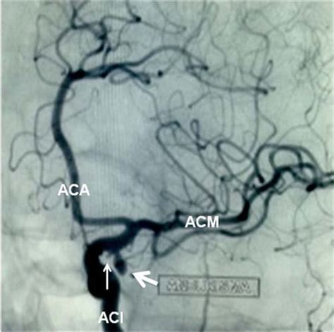 Angiografia Cerebral Mostrando Um Aneurisma Sacular Seta Maior Da