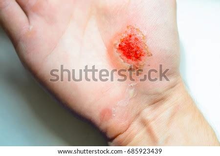 Skin Abrasion Stock Images, Royalty-Free Images & Vectors | Shutterstock