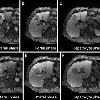 Abdominal Gd Eob Dtpa Mri Findings A C The Liver Tumor Of Segment