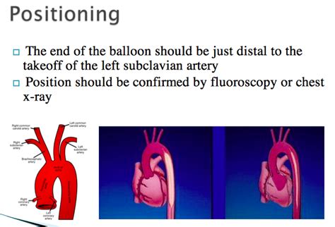 Intra Aortic Balloon Pump Iabp Positioning Balloon Pump Travel