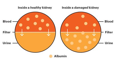 Risk Factors And Precautions For Protein In Urine Ask The Nurse Expert