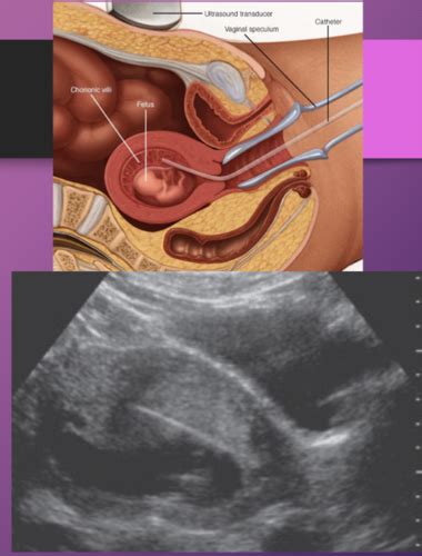 Ch Prenatal Diagnosis Of Congenital Anomalies Flashcards Quizlet