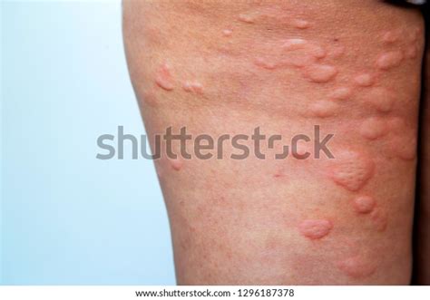 Skin Rash Legs Stock Photo Edit Now 1296187378