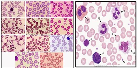 Lecture 4 Abnormal RBC WBC Morphology Diagram Quizlet