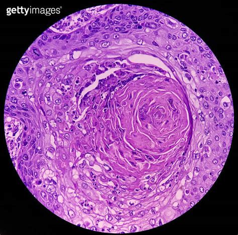 Tissue From Axilla Biopsy Invasive Squamous Cell Carcinoma Smear