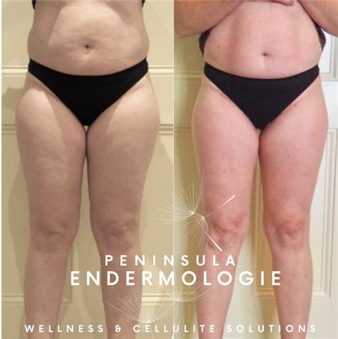 BEFORE AFTER PHOTOS Peninsula Endermologie