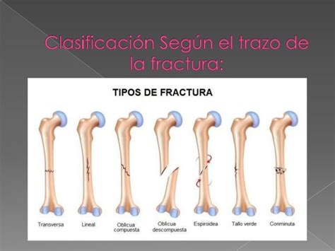 Tipos De Fracturas