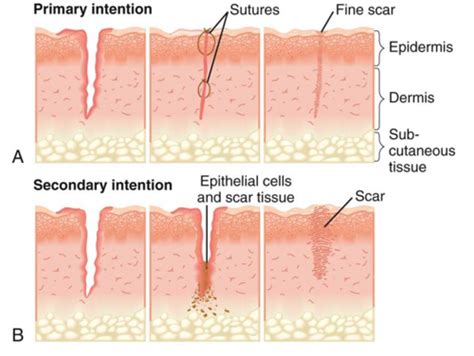 Wound Healing and Infection Control Flashcards | Quizlet