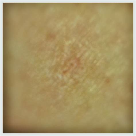 How to get rid of a scar? Plus pictures of my spider bite.