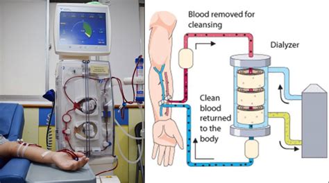 Haemodialysis