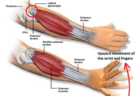 Tennis Elbow What Is It Fox Physiotherapy