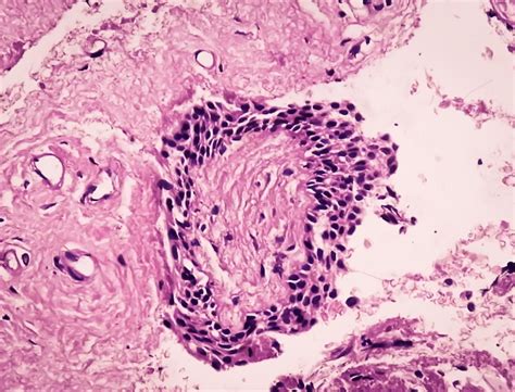 Premium Photo Histology Of Urachal Cyst Photomicrograph Of