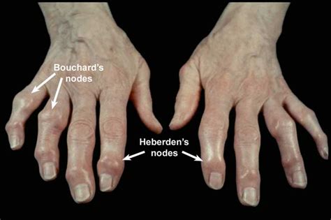 Heberden Nodes