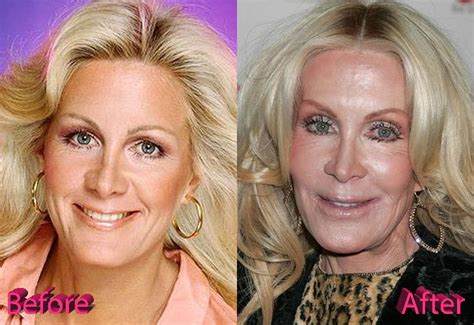 Joan Van Ark Plastic Surgery: When Everything Goes Wrong