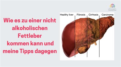 Wie Es Zu Einer Nicht Alkoholischen Fettleber Kommen Kann Und Meine