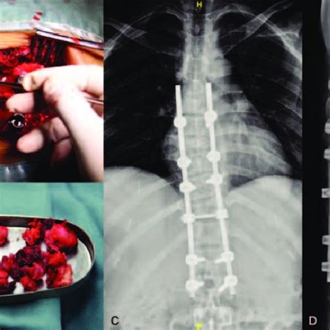 A Intraoperative Photography Depicting The Exposed Spinal Cord B