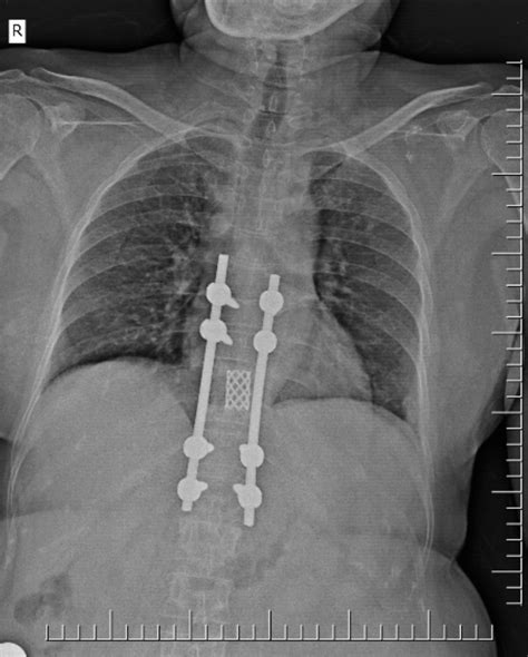 Titanium Mesh Cage For Spinal Fusion Surgery Image