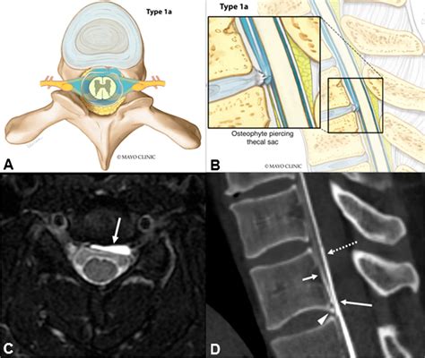 dural sac tear late   dural tears  case reports