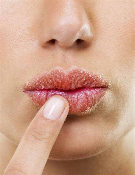 6 Ways To Prevent Chapped Lips