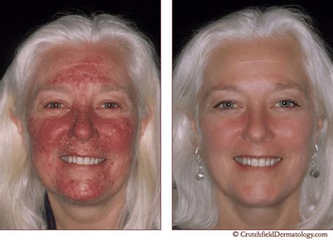 Laser Treatment For Rosacea Efficacy Before And Afters Cost And More