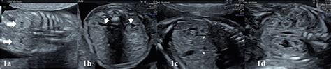 Fetal Hydronephrosis Ultrasound