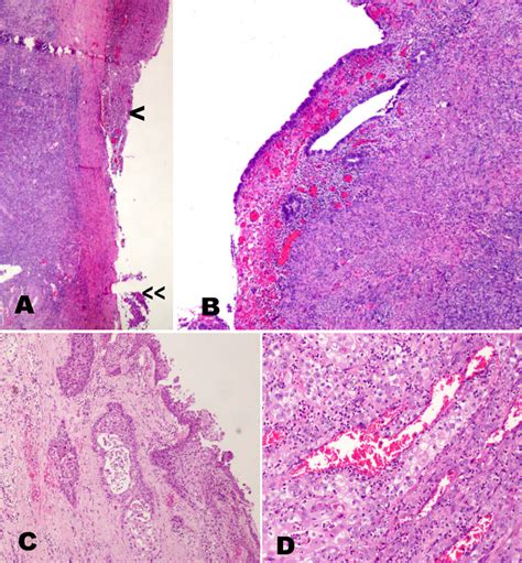 Histological Sections Showing Primary Squamous Cell Carcinoma Of The