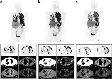 68 Ga DOTATOC PET CT in a metastatic Hü rthle cell carcinoma at