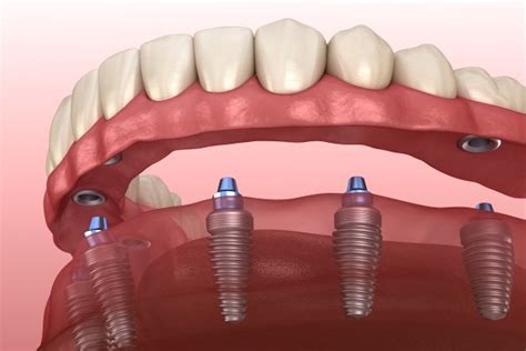 Implant Supported Dentures Vs Traditional Dentures St George Dental