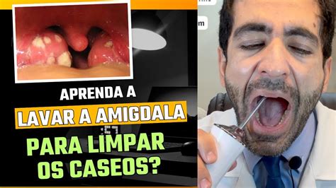 Como Lavar A Amigdala Para Tirar Os Caseos Da Garganta As Massinhas