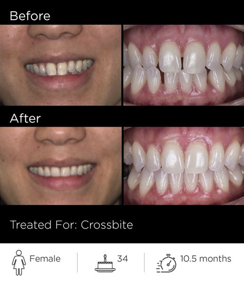 SureSmile Before & After Gallery | SureSmile USA