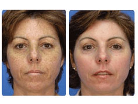 Sciton Microlaserpeel Laser Skin Rejuvenation Charlotte Nc