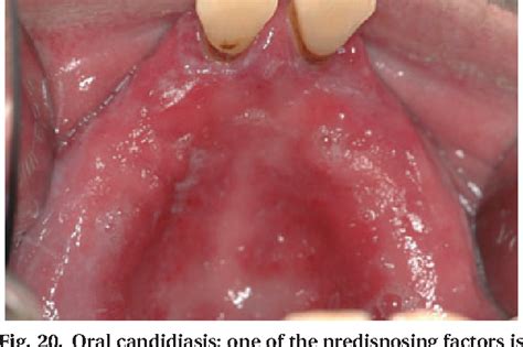 Figure From Acute Periodontal Lesions Semantic Scholar